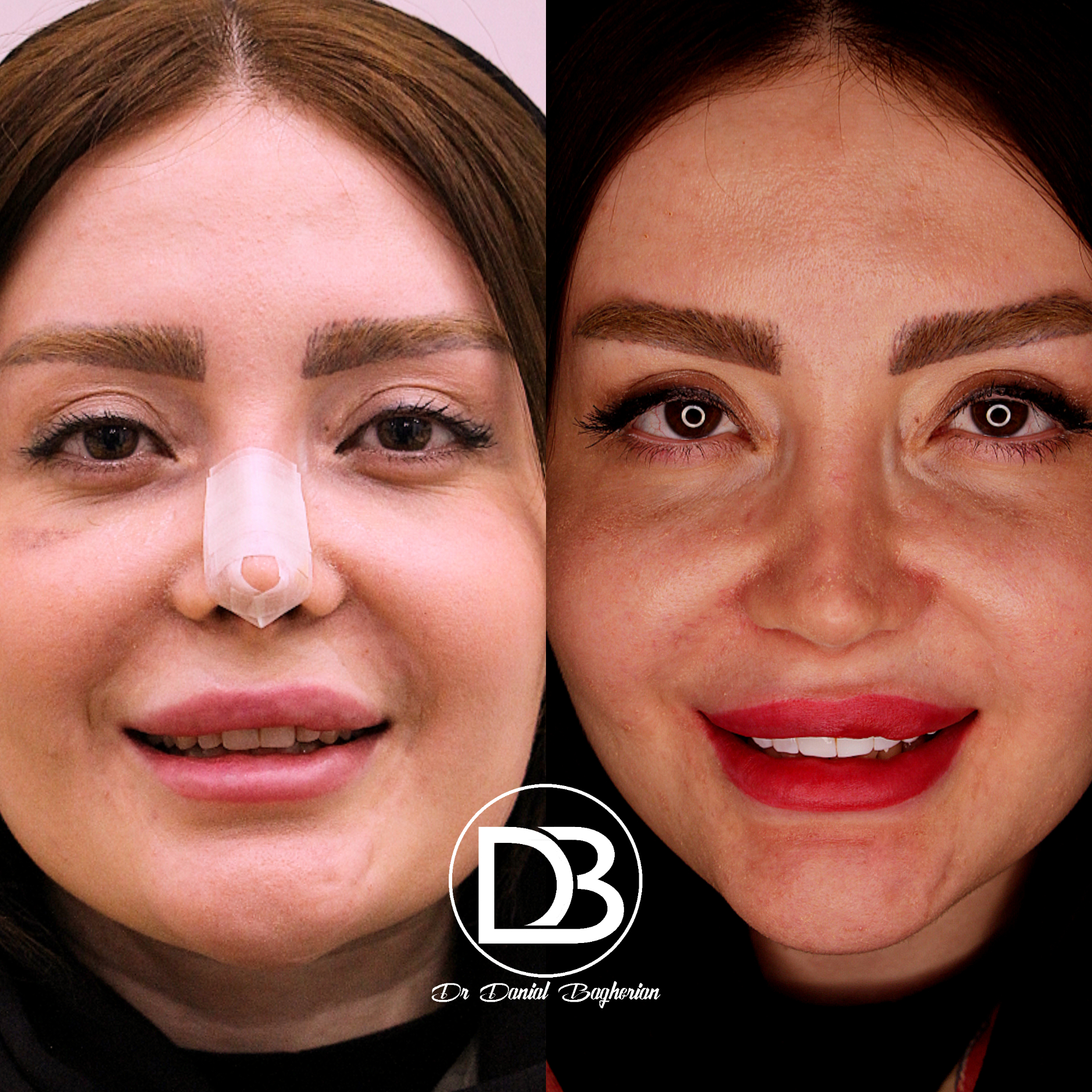 ونبر کامپوزیت در زرین شهر