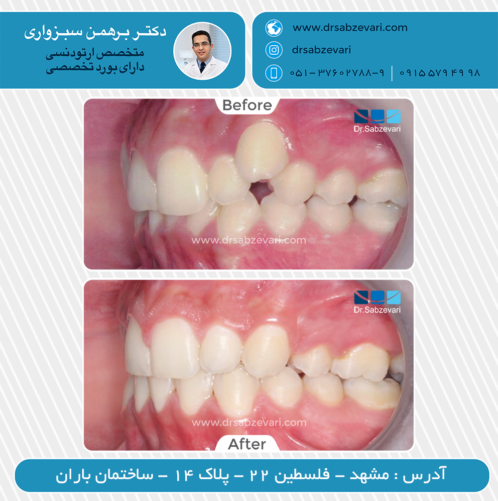 گالری نمونه کار های ارتودنسی دکتر برهمن سبزواری در مشهد | بهترین متخصص ارتودنسی مشهد