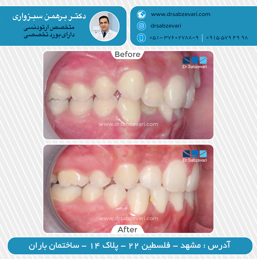 گالری نمونه کار های کلینیک ارتودنسی دکتر برهمن سبزواری در مشهد | بهترین متخصص ارتودنسی مشهد
