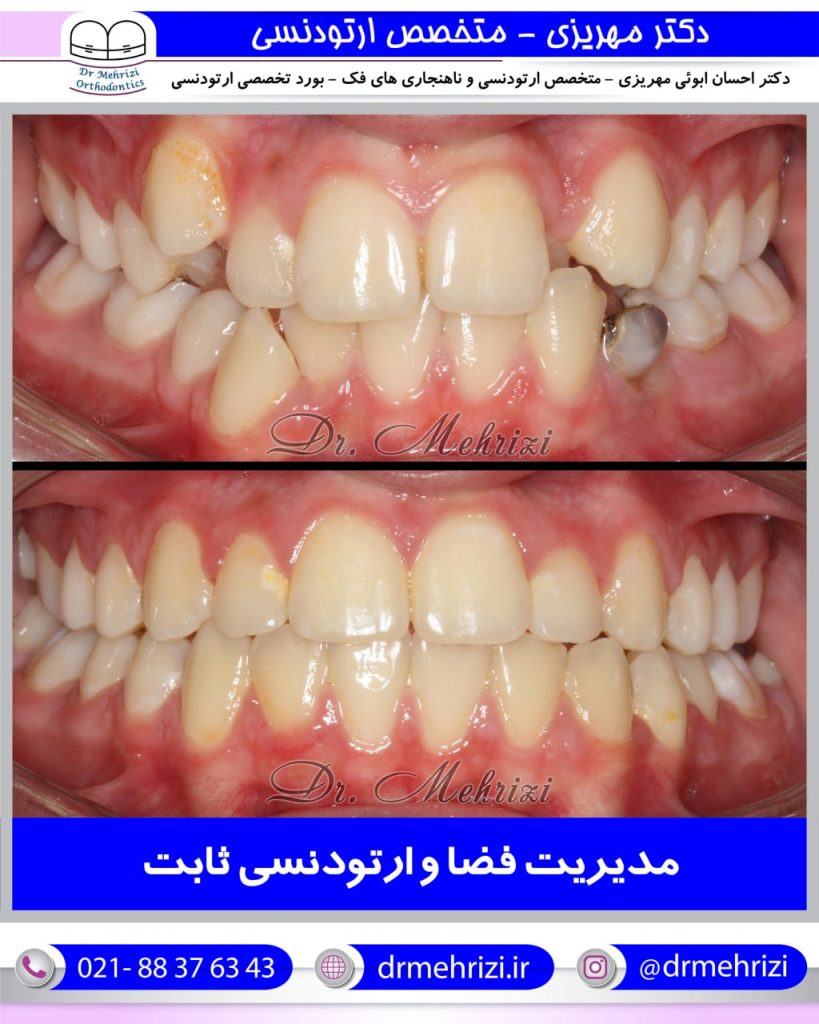 نمونه درمان های دکتر احسان مهریزی | بهترین دکتر ارتودنسی دندان در تهران