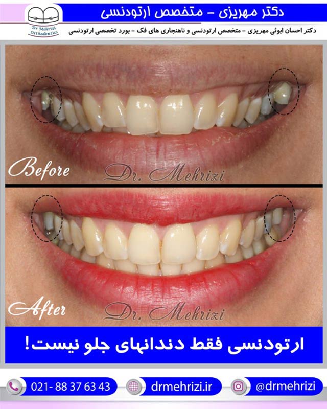 گالری درمان های دکتر احسان مهریزی | بهترین متخصص ارتودنسی دندان در تهران