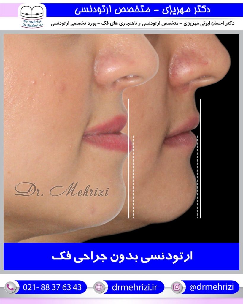 نمونه درمان های دکتر احسان مهریزی | بهترین دکتر ارتودنسی دندان در تهران