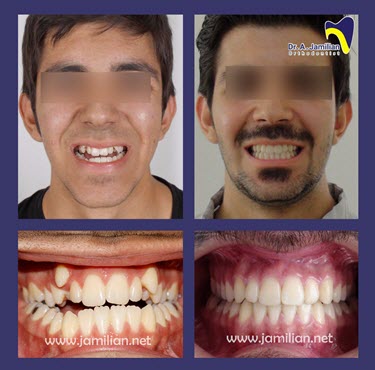 نمونه درمان ارتودنسی دندان در مطب دکتر جمیلیان | بهترین دکتر ارتودنسی دندان در تهران