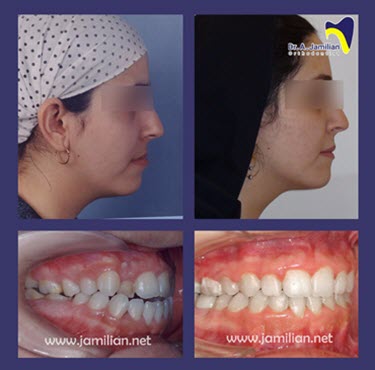 نمونه درمان ارتودنسی دندان در مطب دکتر جمیلیان | بهترین دکتر ارتودنسی دندان در تهران