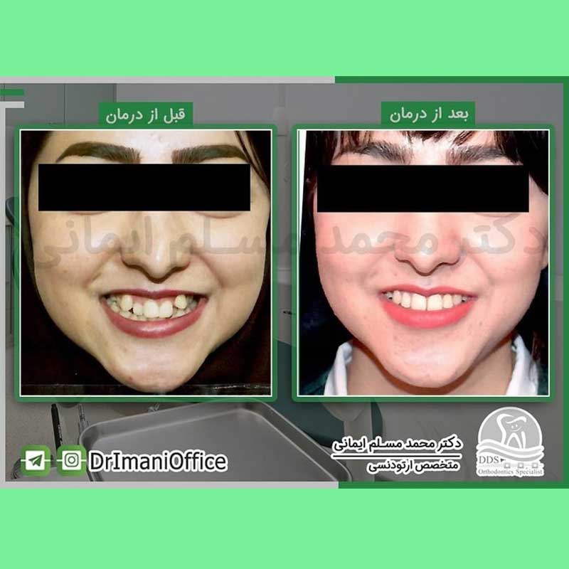 گالری نمونه کار های دکتر مسلم ایمانی | بهترین دکتر ارتودنسی در کرمانشاه