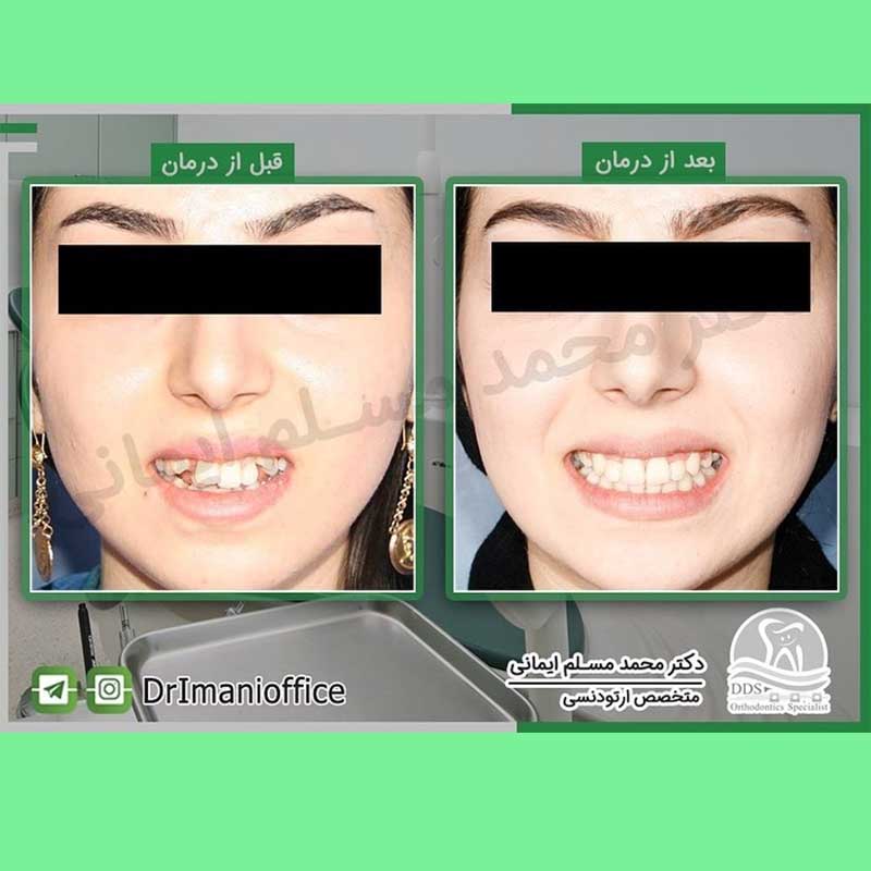 نمونه کار های دکتر مسلم ایمانی | بهترین متخصص ارتودنسی کرمانشاه