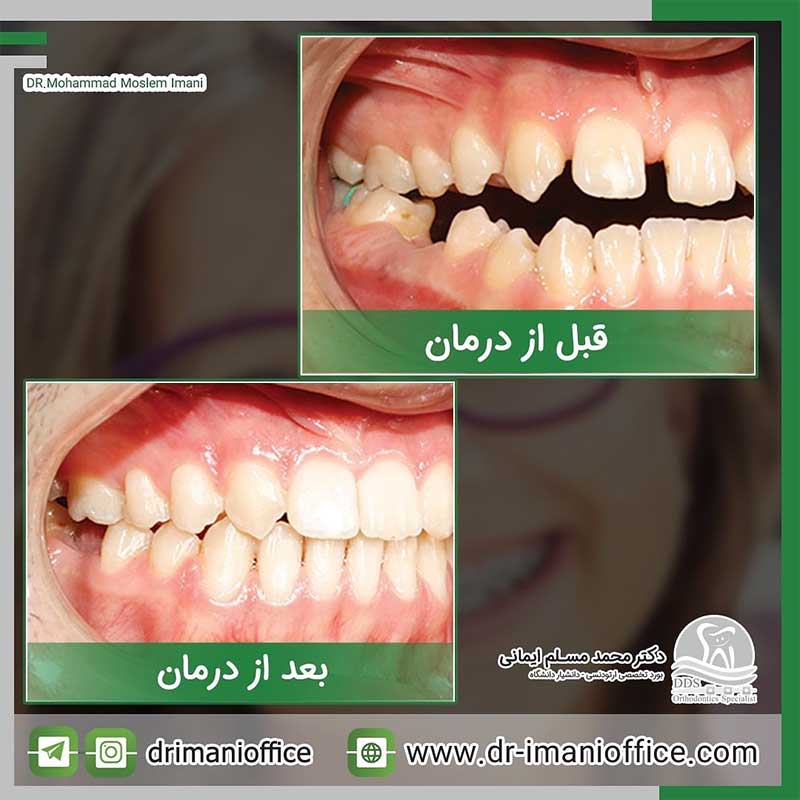 گالری نمونه کار های دکتر مسلم ایمانی | بهترین دکتر ارتودنسی در کرمانشاه
