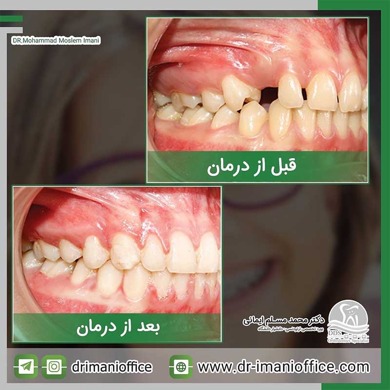 نمونه کار های دکتر مسلم ایمانی | بهترین متخصص ارتودنسی کرمانشاه