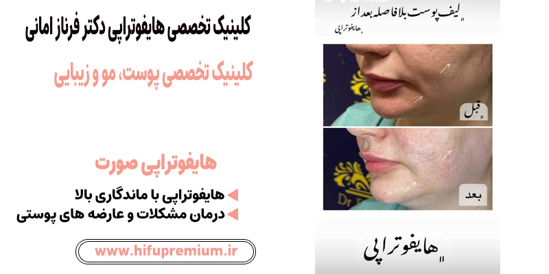 عکس قبل و بعد از هایفوتراپی در کلینیک زیبایی دکتر امانی_ هایفوپریمیوم