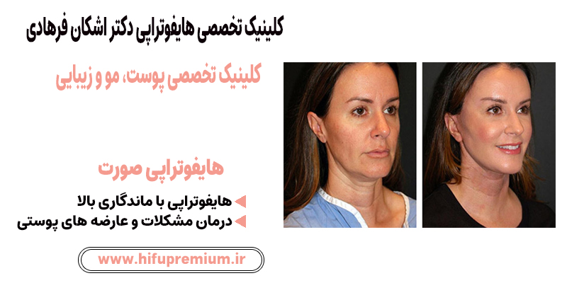 عکس قبل و بعد از هایفوتراپی در کلینیک زیبایی دکتر فرهادی_ هایفوپریمیوم