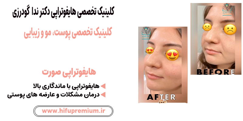 عکس قبل و بعد هایفوتراپی در کلینیک زیبایی گودرزی_ هایفوپریمیوم