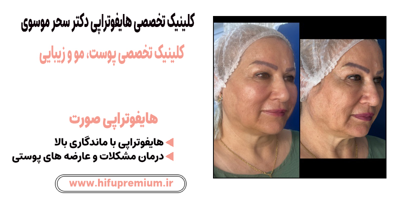 عکس قبل و بعد از هایفوتراپی در کلینیک زیبایی دکتر موسوی_ هایفوپریمیوم