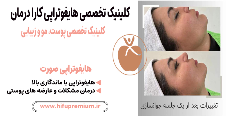عکس قبل و بعد هایفوتراپی در کلینیک کارا درمان_ هایفوپریمیوم