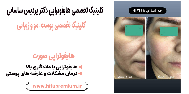عکس قبل و بعد هایفوتراپی در کلینیک پردیس ساسانی_ هایفوپریمیوم
