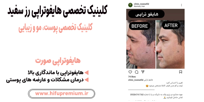 عکس قبل و بعد هایفوتراپی در کلینیک رز سفید_ هایفوپریمیوم