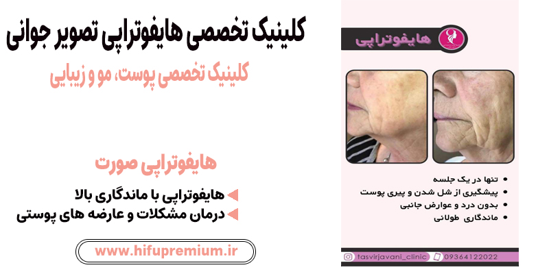 عکس قبل و بعد هایفوتراپی در کلینیک تصویر جوانی_ هایفوپریمیوم