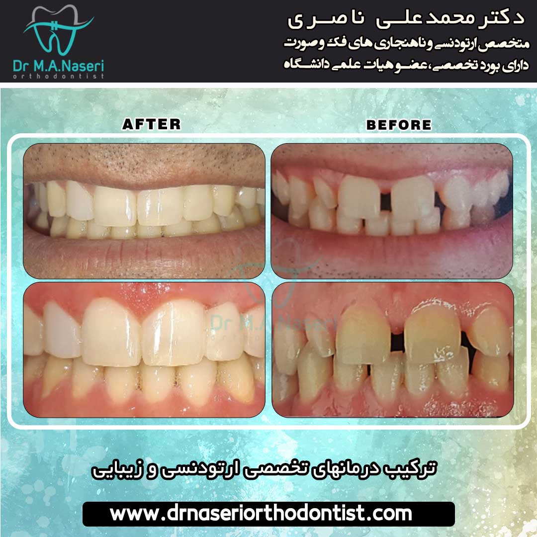 نمونه کار ارتودنسی و حذف فاصله بین دندان ها توسط دکتر محمد علی ناصری | بهترین متخصص ارتودنسی اصفهان