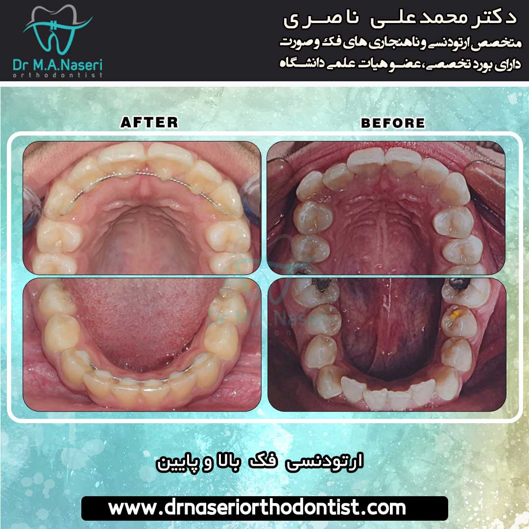 نمونه کار ارتودنسی و تراز فک دکتر محمد علی ناصری | بهترین متخصص ارتودنسی اصفهان