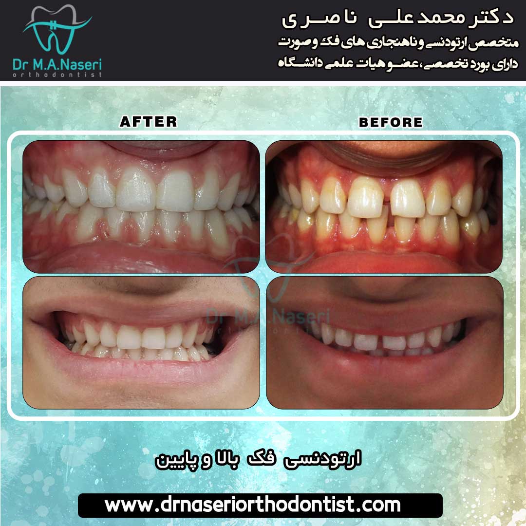 نمونه کار ارتودنسی و تراز فک دکتر محمد علی ناصری | بهترین متخصص ارتودنسی اصفهان