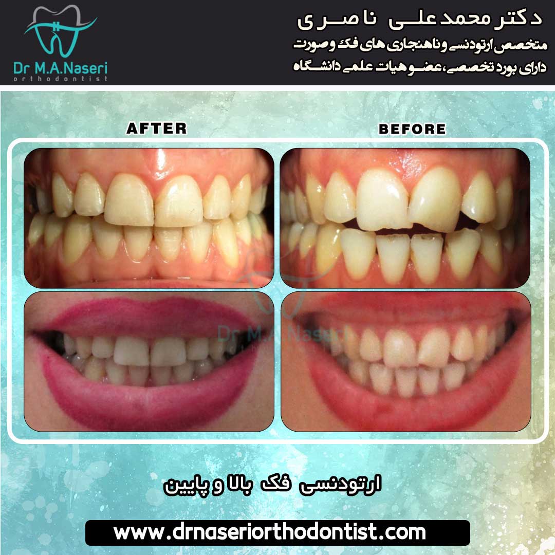 نمونه کار ارتودنسی و تراز فک دکتر محمد علی ناصری | بهترین متخصص ارتودنسی اصفهان