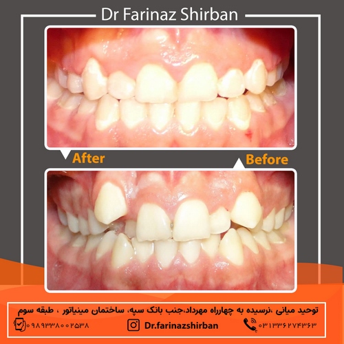 نمونه درمان ارتتودنسی در اصفهان