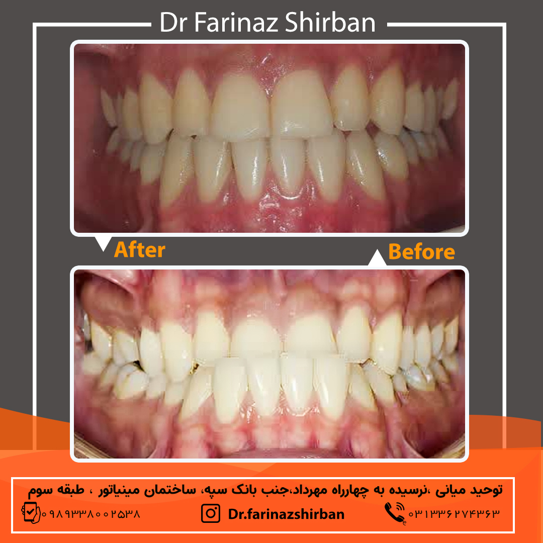 نمونه درمان ارتتودنسی در اصفهان