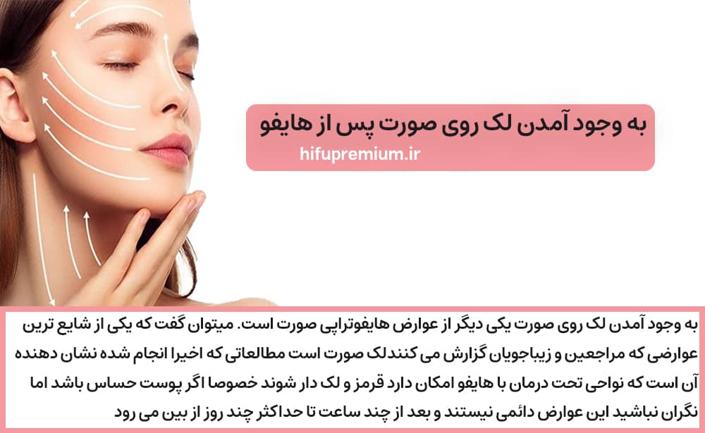 به وجود آمدن لک روی صورت پس از هایفو