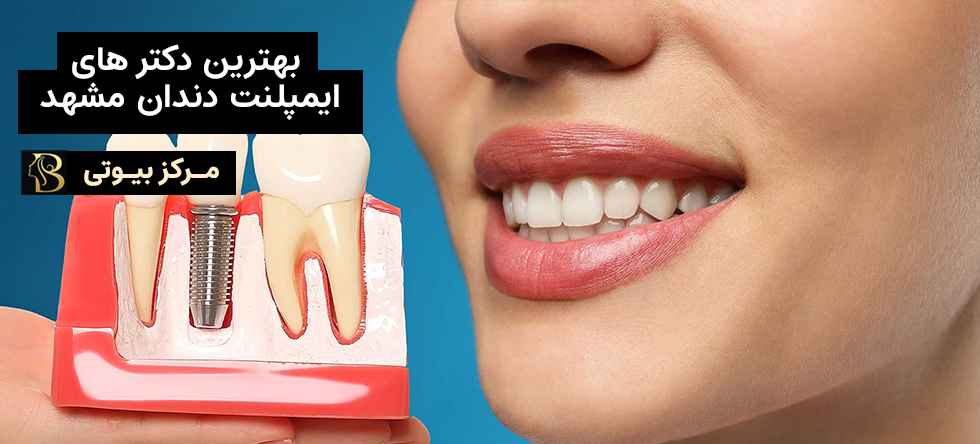بهترین متخصص های ایمپلنت دندان مشهد | مرکز بیوتی