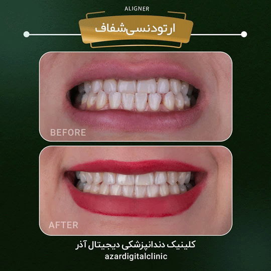 نمونه کار دکتر راضیه فضائلی در کلینیک آذر | مرکز بیوتی