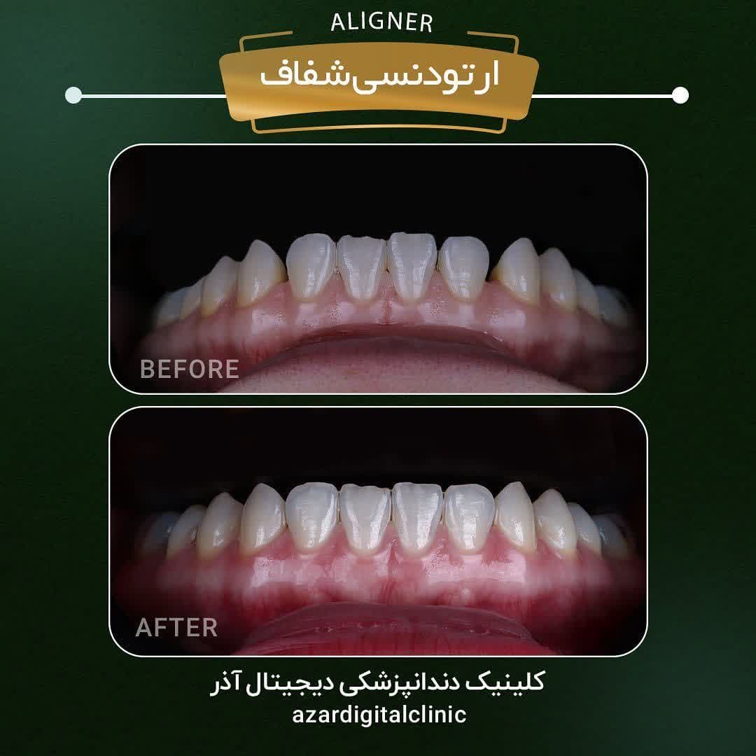 نمونه کار دکتر راضیه فضائلی در کلینیک آذر | مرکز بیوتی