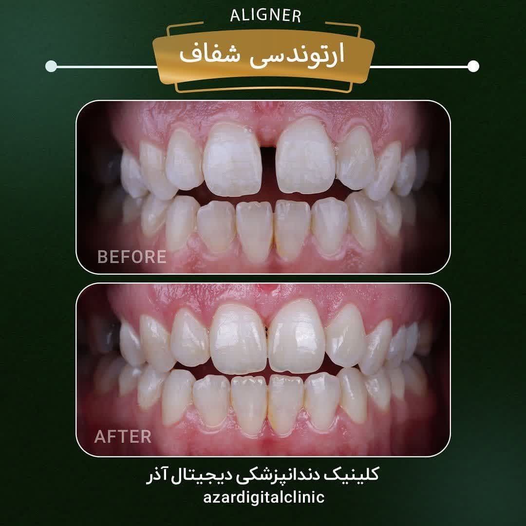 نمونه کار دکتر راضیه فضائلی در کلینیک آذر | مرکز بیوتی