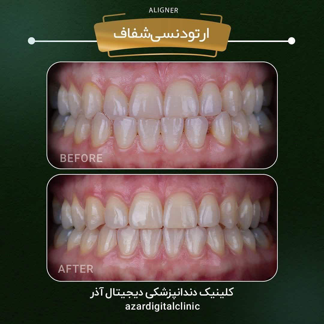 نمونه کار دکتر راضیه فضائلی در کلینیک آذر | مرکز بیوتی