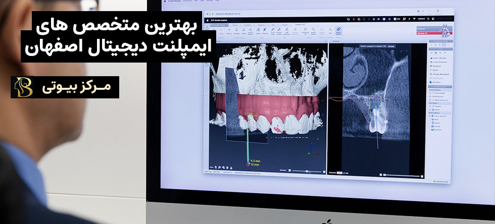 ایمپلنت دیجیتال اصفهان | مرکز بیوتی