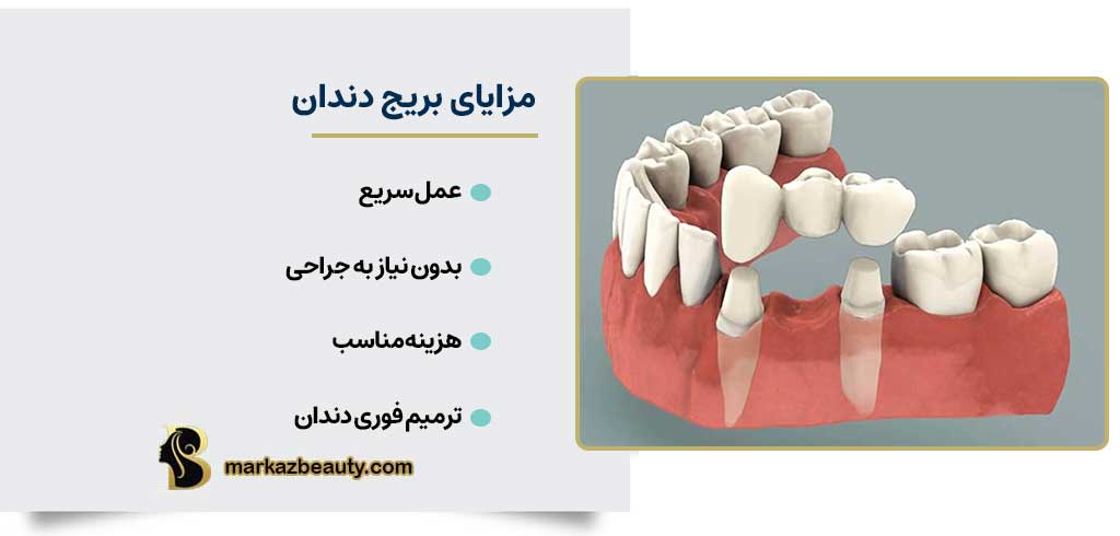 مزایای بریج دندان | مرکز بیوتی