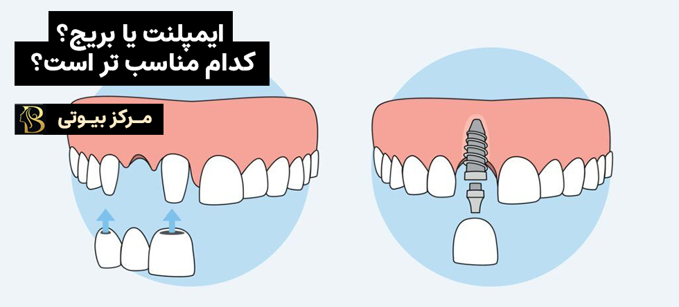 ایمپلنت یا بریج؟ کدام مناسب تر است؟ | مرکز بیوتی