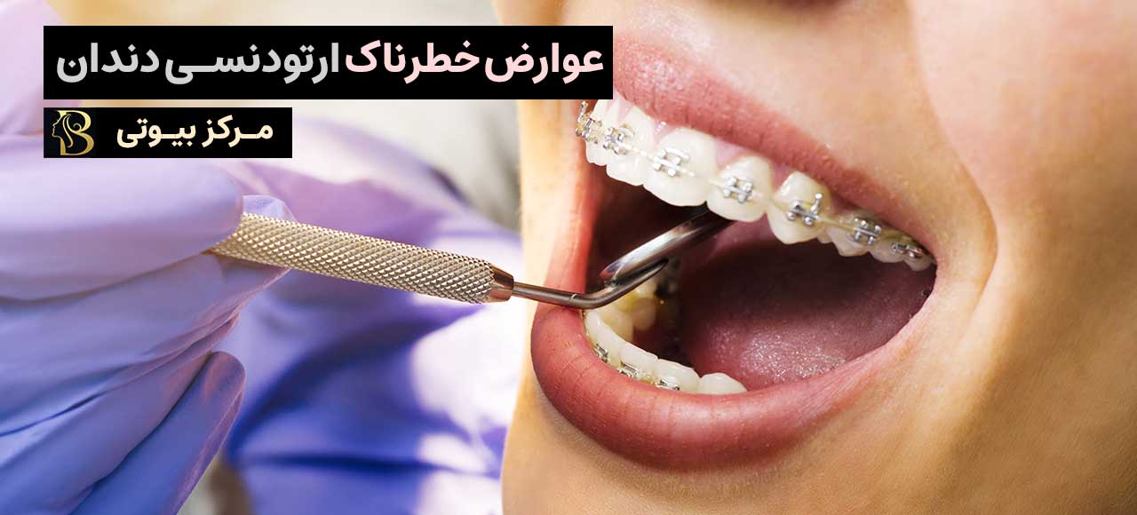 عوارض خطرناک ارتودنسی دندان | مرکز بیوتی