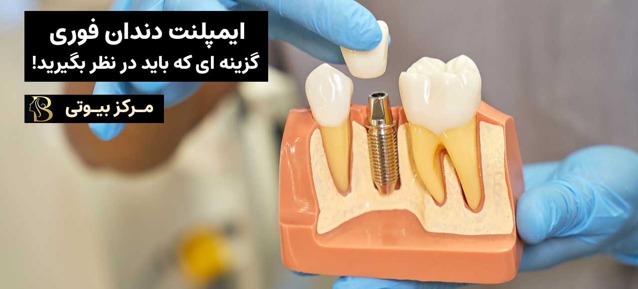 ایمپلنت دندان فوری: گزینه ای که باید در نظر بگیرید! | مرکز بیوتی