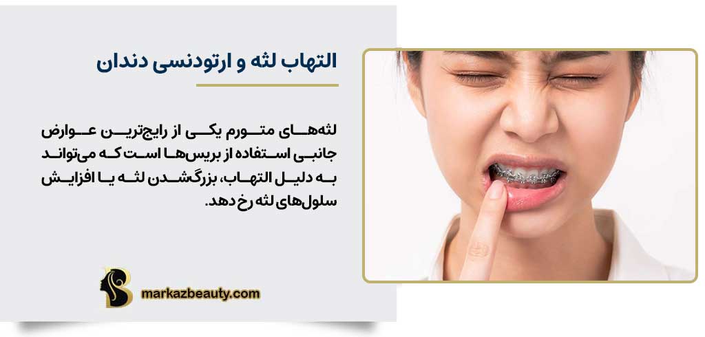 آشنایی تورم لثه با بریس‌های ارتودنسی | مرکز بیوتی