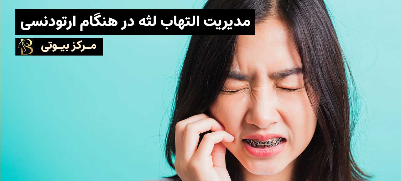 مدیریت التهاب لثه در هنگام ارتودنسی: راهبردهای مؤثر | مرکز بیوتی