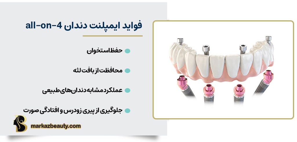 فواید ایمپلنت دندان All-On-4 |مرکز بیوتی
