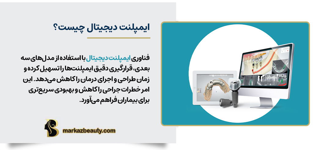ایمپلنت دندان دیجیتال چیست؟ | مرکز بیوتی