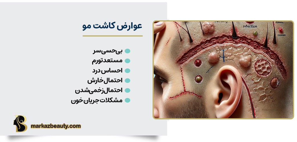 عوارض کاشت مو | مرکز بیوتی
