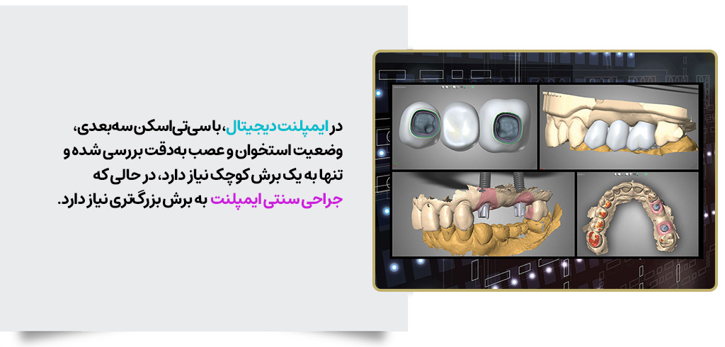 چرا جراحی ایمپلنت دندان دیجیتال راحتتر است؟ | مرکز بیوتی