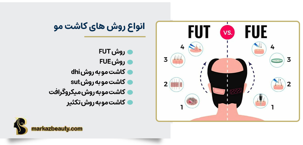 انواع روش های کاشت مو | مرکز بیوتی