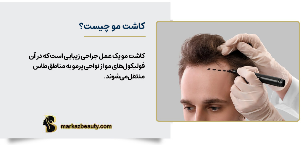 کاشت مو چیست؟ | مرکز بیوتی