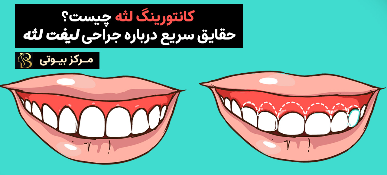 کانتورینگ لثه چیست؟ حقایق سریع درباره جراحی کانتورینگ لثه | مرکز بیوتی