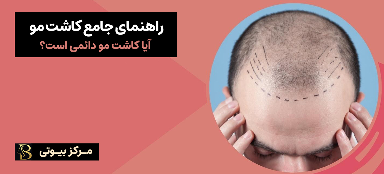 راهنمای جامع کاشت مو | آیا کاشت مو دائمی است؟ | مرکز بیوتی
