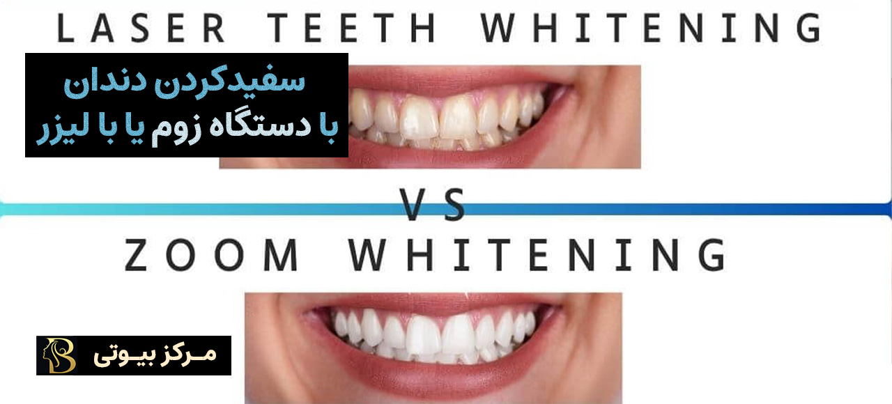 سفیدکردن دندان با دستگاه زوم یا با لیزر | مرکز بیوتی
