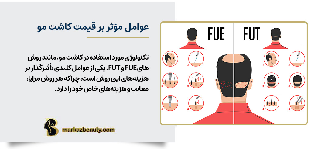 عوامل مؤثر بر هزینه پیوند مو مانند تکنولوژی مورداستفاده پیوند مو 