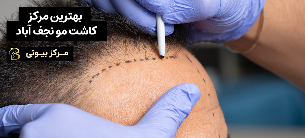 کاشت مو نجف آباد | مرکز بیوتی